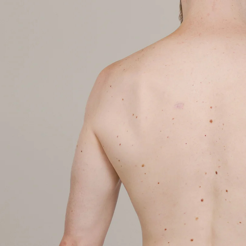 KI-gestützte Hautanalyse KI-gestützte Hautanalyse